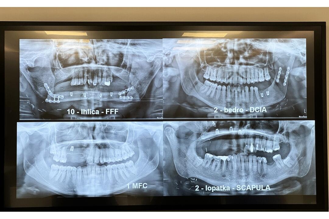 FOTO: Banskobystrická nemocnica zavádza inovatívne dentálne implantáty, foto 2