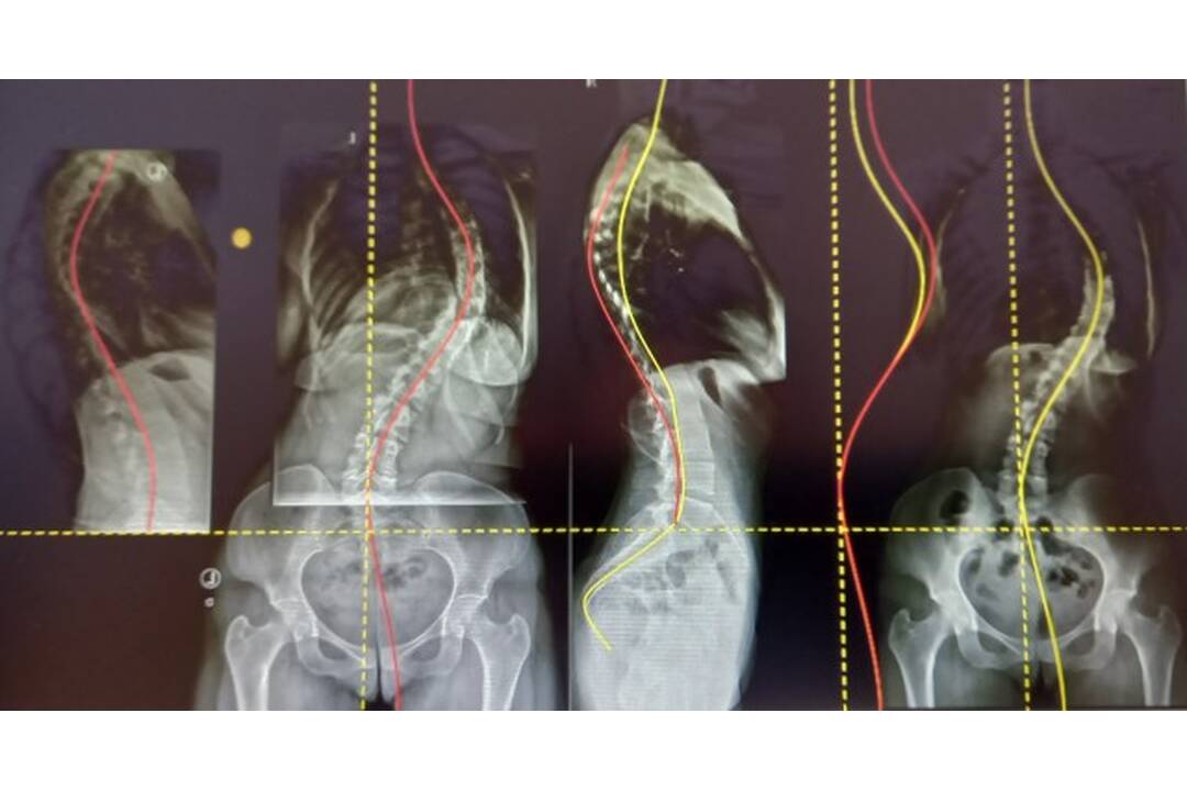 FOTO: Júlia o život bojuje od svojich 14-rich rokov, foto 5