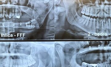 FOTO: Banskobystrická nemocnica zavádza inovatívne dentálne implantáty