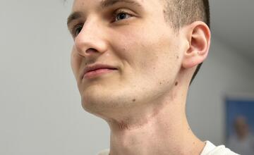 FOTO: Banskobystrická nemocnica zavádza inovatívne dentálne implantáty