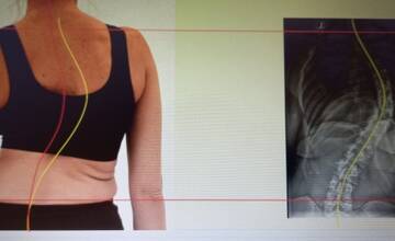 FOTO: Júlia o život bojuje od svojich 14-rich rokov